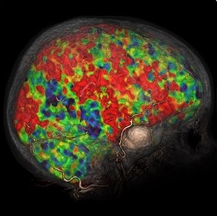 تصویر چهار بعدی CT از تحلیل مغزی برای fX
