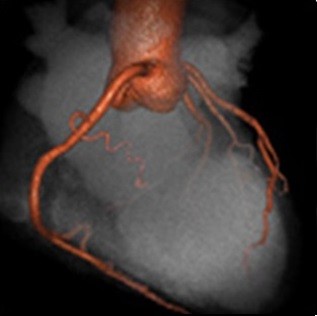 تصویر CT از تحلیل قلبی