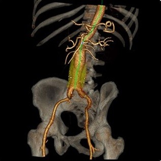 تصویر CT از طراحی Stent درون رگی