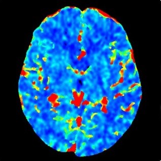 تصویر CT از خون‌رسانی (پرفیوژن) مغز