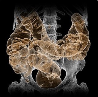 تصویر CT از تحلیل روده بزرگ