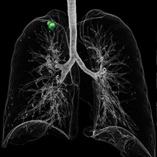 CT Lung Analysis