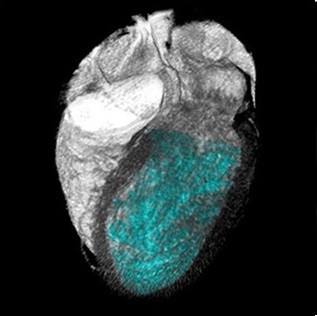 تصویر CT از تحلیل عملکردی قلب