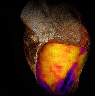 تصویر CT از تحلیل ماهیچه قلبی