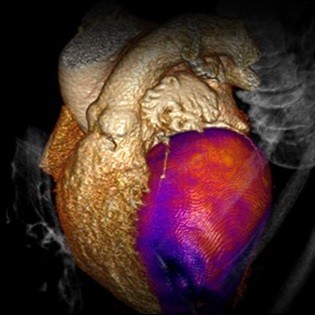 تصویر CT از خون‌رسانی (پرفیوژن) ماهیچه قلبی برای fX