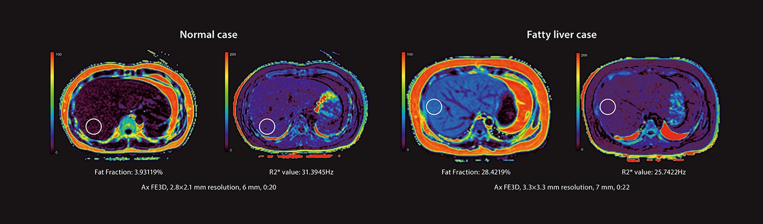 Non-invasive Fat Imaging And Quantification