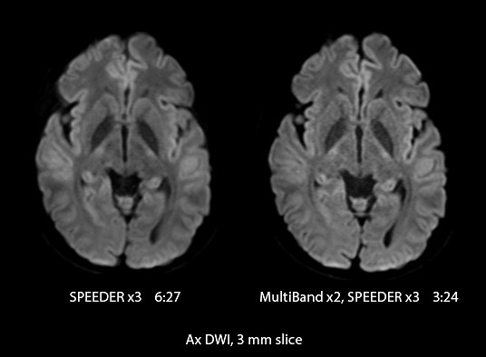 Accelerated Diffusion Weighted Imaging with MultiBand SPEEDER