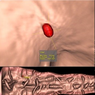 تصویر iCAD VeraLook CT CAD از روده بزرگ