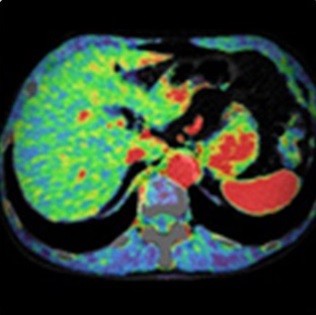تصویر CT چهار بعدی از خون‌رسانی (پرفیوژن) بدن برای fX